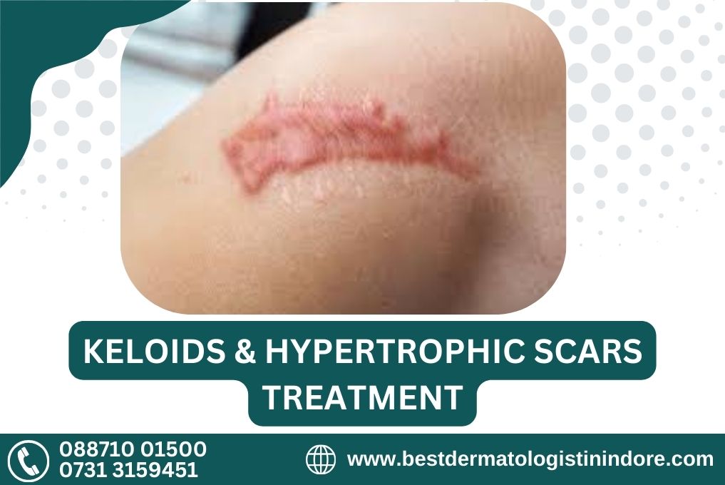 Best Skin Specialist for keloids and Hypertrophic Scars Treatment in Indore